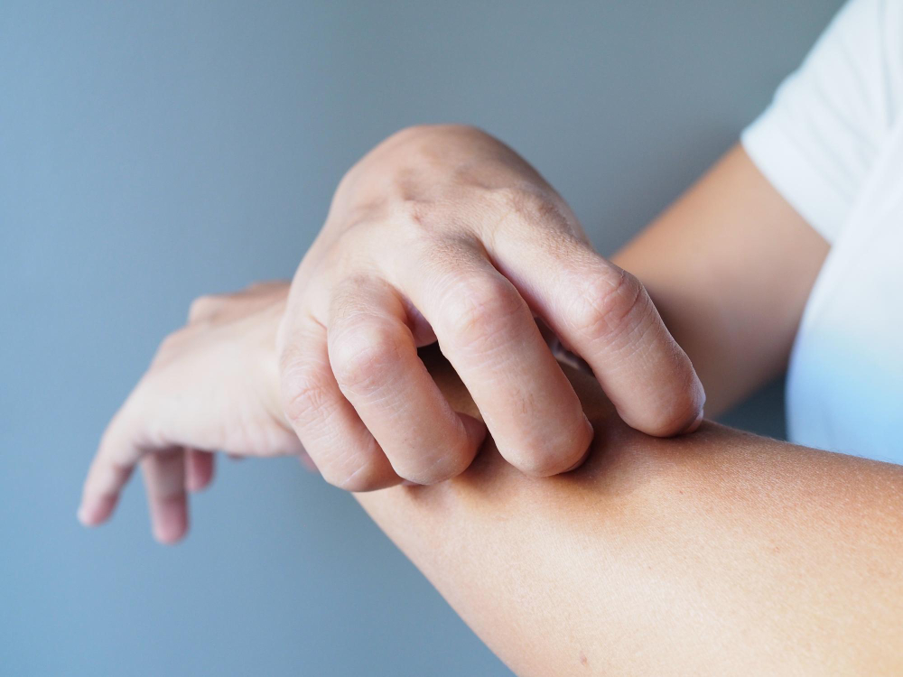 Mulher coçando o braço por conta da doenças de pele - artrite psoriática