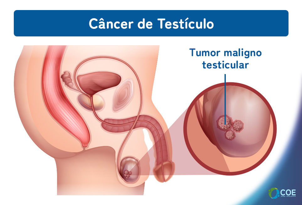 Os testículos fazem parte do sistema reprodutor masculino e estão localizados no saco escrotal, atrás do pênis. São os responsáveis pela produção de espermatozoides e de testosterona, principal hormônio masculino.

O câncer de testículo ocorre quando há uma multiplicação descontrolada das células locais, perdendo suas características basais e formando um tumor. Pode acometer um ou ambos os lados. E assim como outros tumores, possui a capacidade de se espalhar para outros órgãos como pulmão, fígado, sistema linfático, entre outros, tornando-se uma doença metastática.

Pode acometer qualquer faixa etária, no entanto, apresenta maior incidência entre os jovens, dos 15 aos 40 anos.