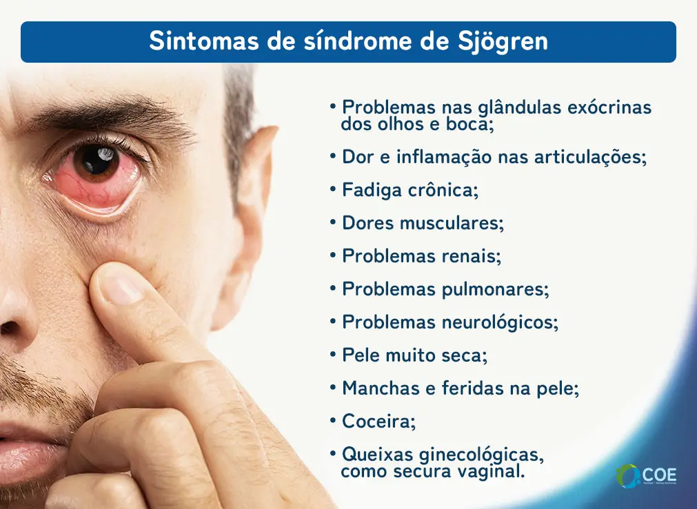 Sintomas de síndrome de Sjögren Problemas nas glândulas exócrinas dos olhos e boca; Dor e inflamação nas articulações; Fadiga crônica; Dores musculares; Problemas renais; Problemas pulmonares; Problemas neurológicos; Pele muito seca; Manchas e feridas na pele; Coceira; Queixas ginecológicas, como secura vaginal.